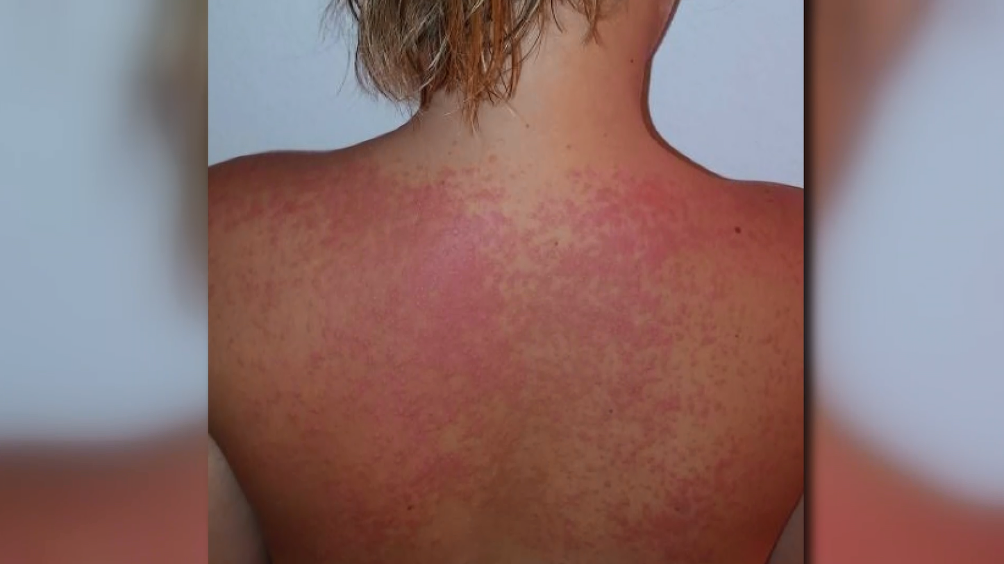 A nasty skin rash? - Picture of Crosby Beach - Tripadvisor