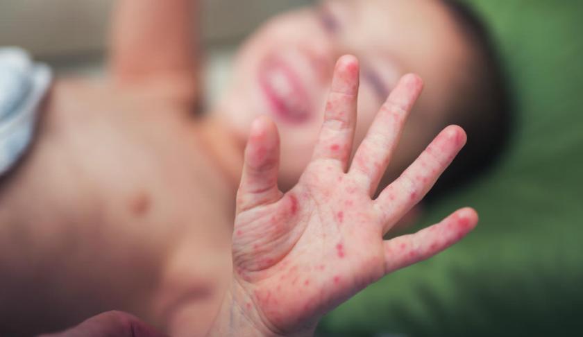 A child with measles. Photo via CBS.