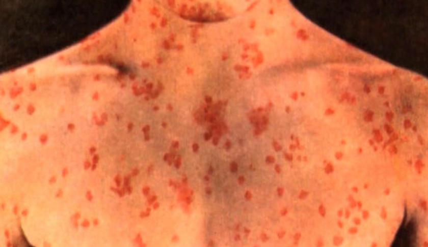 Person with measles. (Credit: CBS News)