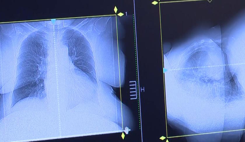 Lung cancer rates have been historically higher among men than women, but new research reveals that trend has flipped in younger Americans. (Credit: CBS News)