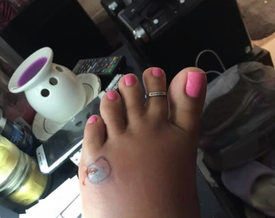 Leann Thibodeau loves the beach but did not expect to contract flesh-eating bacteria on her foot. (Credit: Leann Rose)