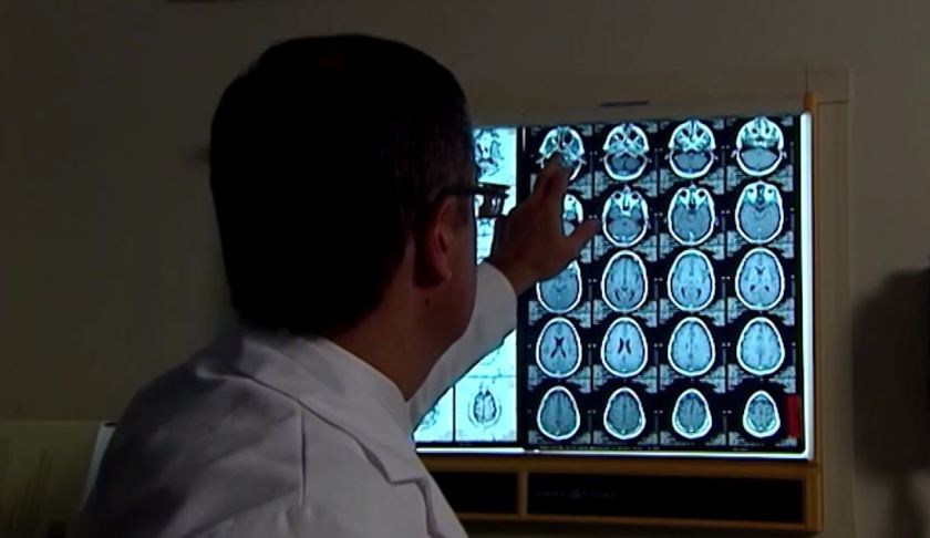 Doctor points at Parkinson indication in the brain. (Credit: WINK News)