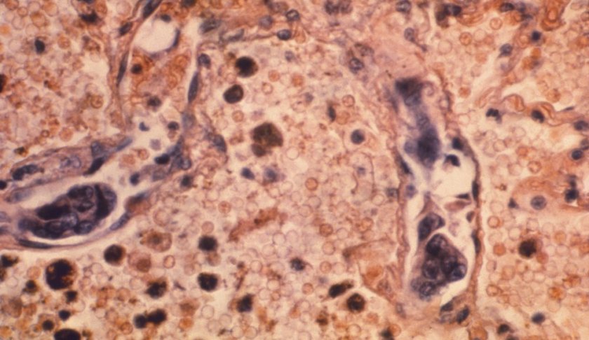 This 1964 photo made available by the Centers for Disease Control and Prevention shows a lung tissue specimen from a patient with adenocarcinoma of the lung. On Wednesday, Jan. 8, 2020, researchers reported the largest-ever decline in the U.S. cancer death rate, and they are crediting advances in the treatment of lung tumors. Most lung cancer cases are tied to smoking, and decades of declining smoking rates means lower rates of lung cancer diagnoses and deaths. (Dr. Ellis/Emory University, Department of Pathology/CDC via AP)