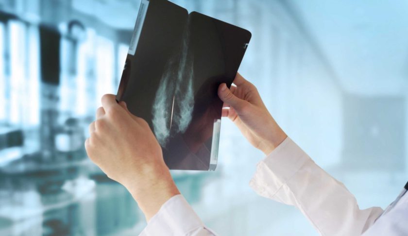 Google says it has developed an artificial intelligence system that can detect the presence of breast cancer more accurately than doctors. (Credit: Shutterstock)