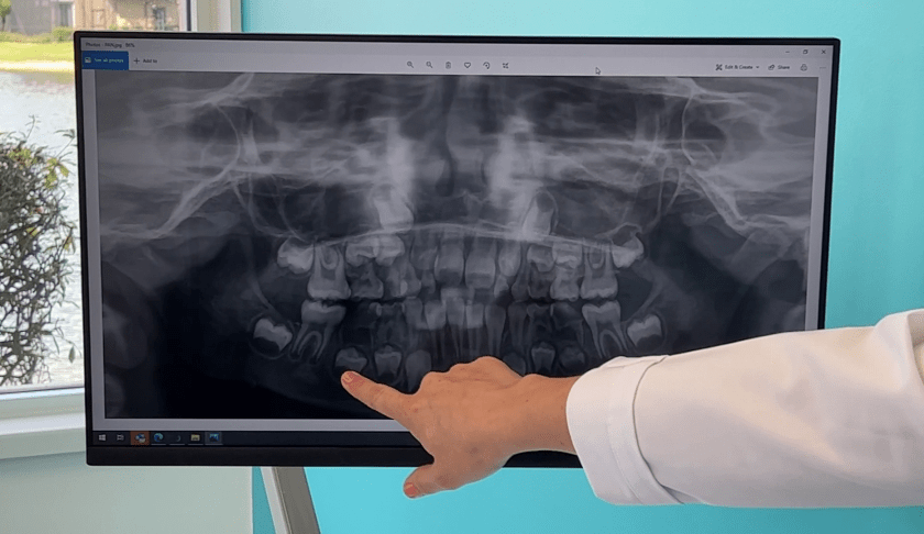 Pediatric dentistry X-ray