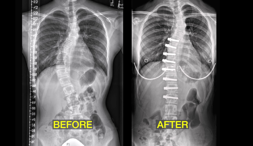 SCOLIOSIS kids teens and adults