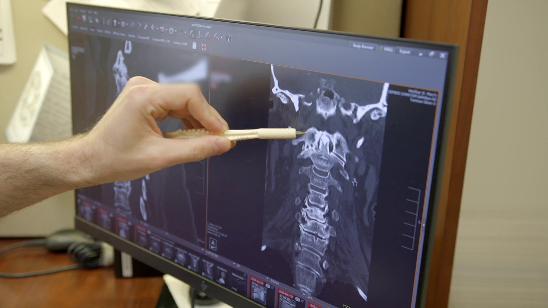 Revolutionary new technology transforms treatment for upper spine issues