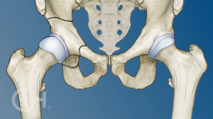 Hip dysplasia